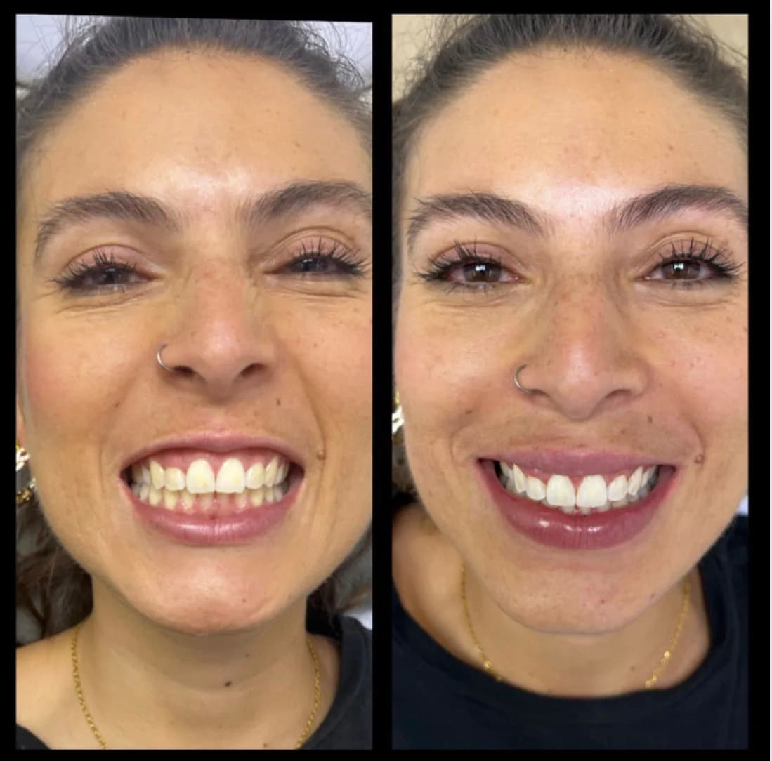 Caso de éxito de micropulido dental - Bifrancy Salazar 1