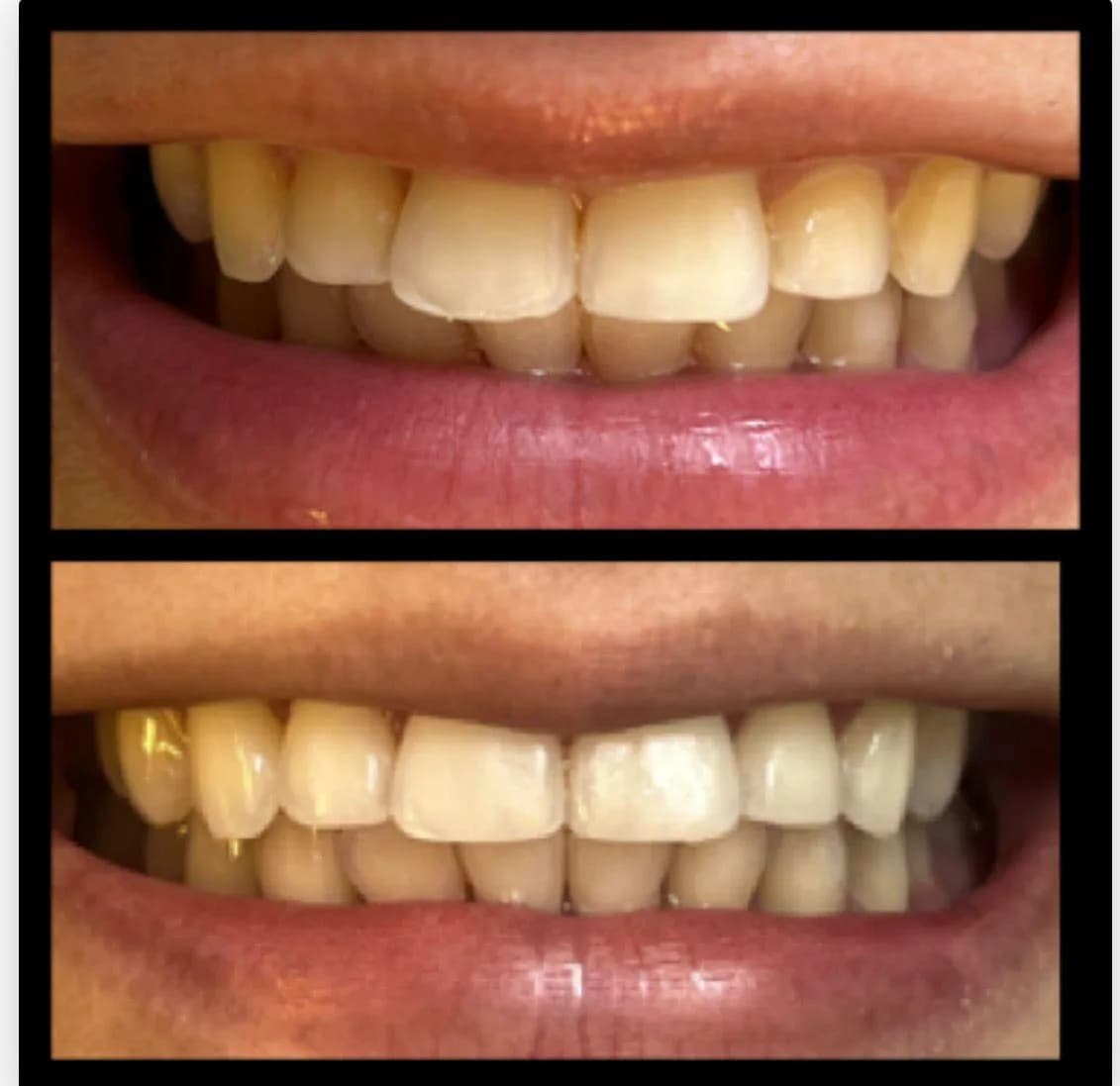 Caso de éxito de micropulido dental - Bifrancy Salazar 6