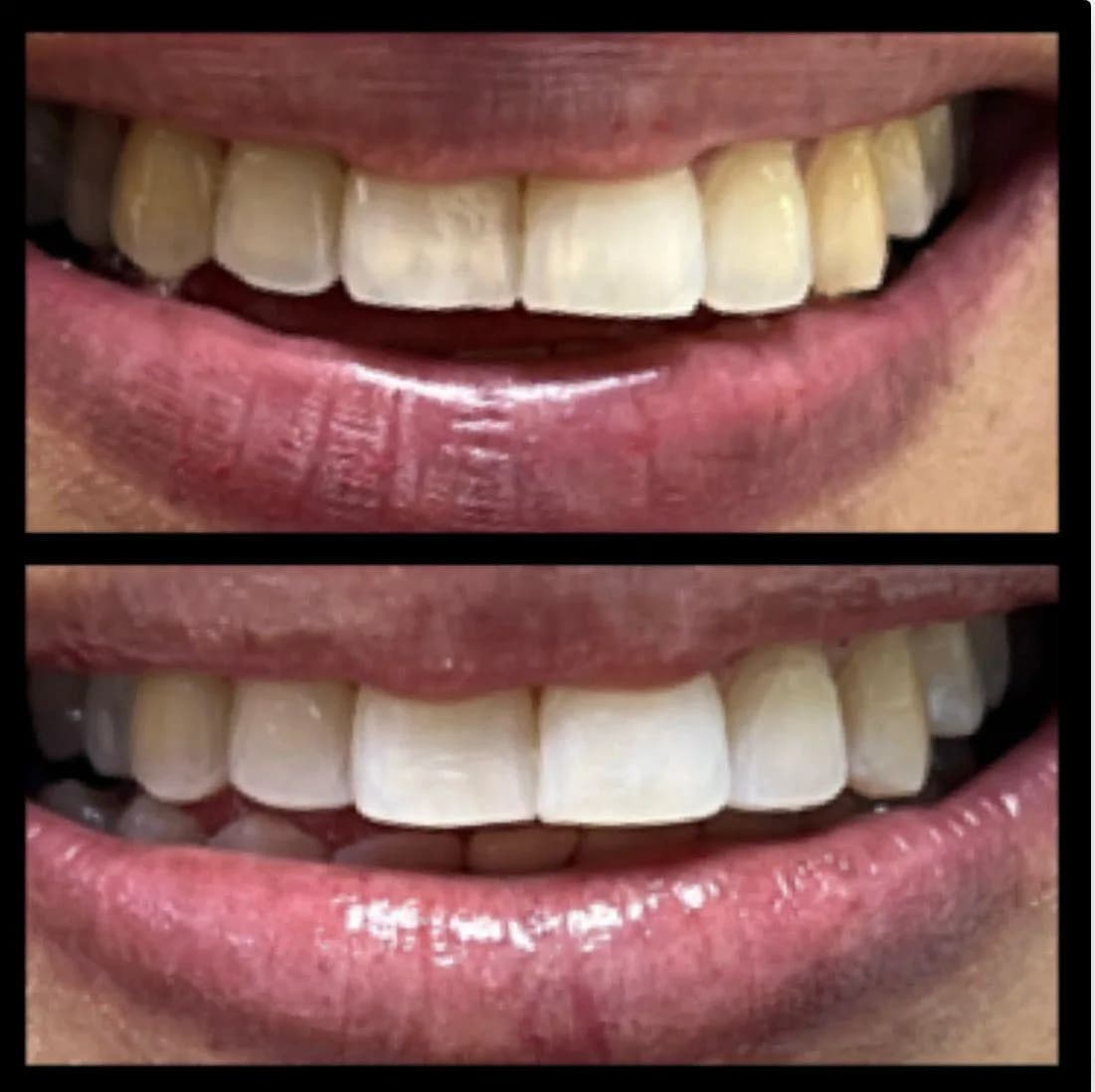Caso de éxito de micropulido dental - Bifrancy Salazar 6
