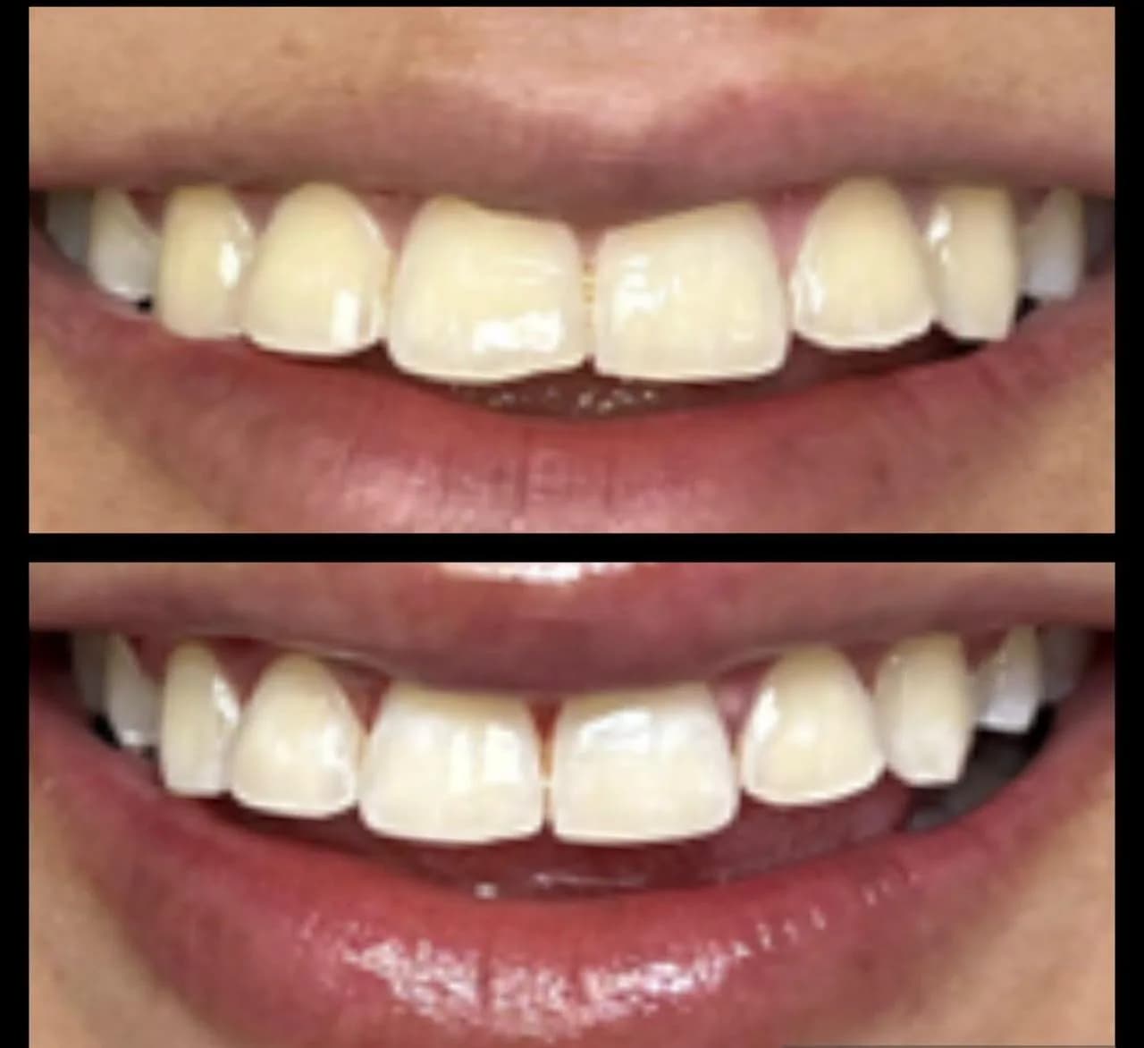 Caso de éxito de micropulido dental - Bifrancy Salazar 6