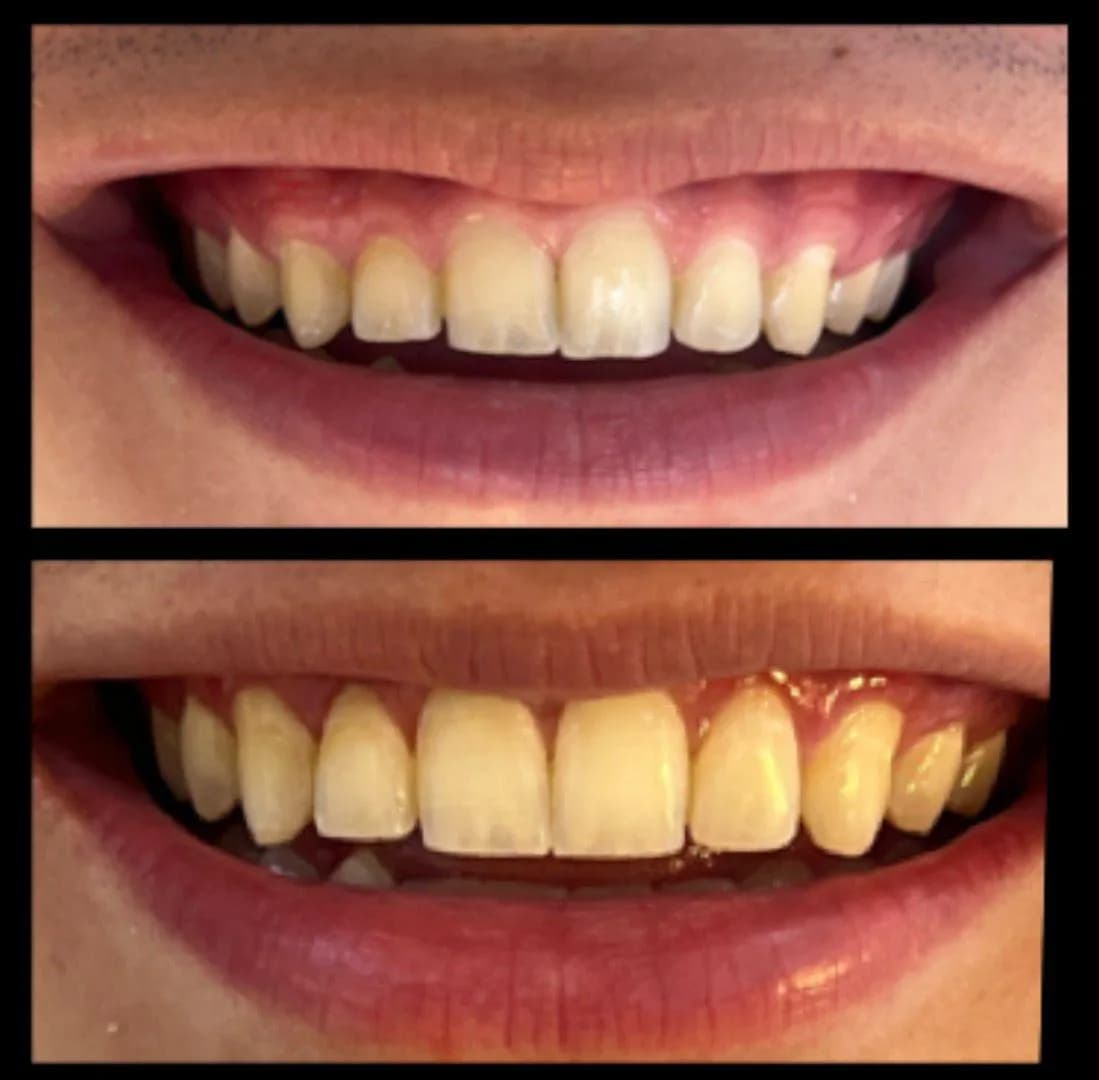 Caso de éxito de micropulido dental - Bifrancy Salazar 6