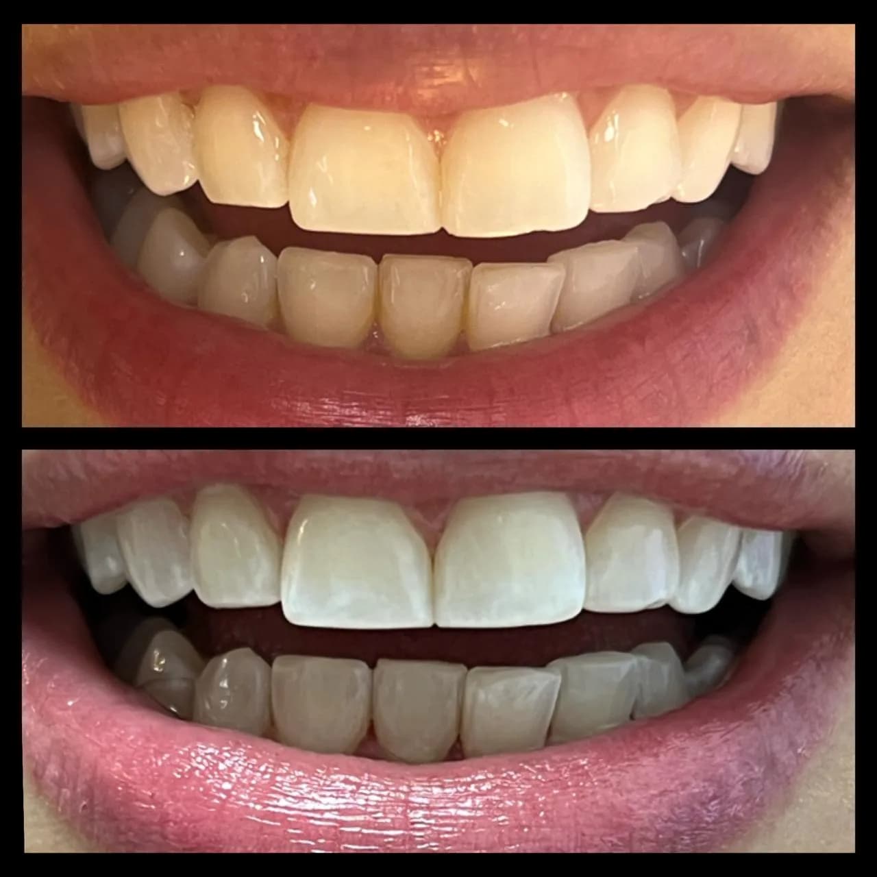 Caso de éxito de contorneo dental - Bifrancy Salazar 3