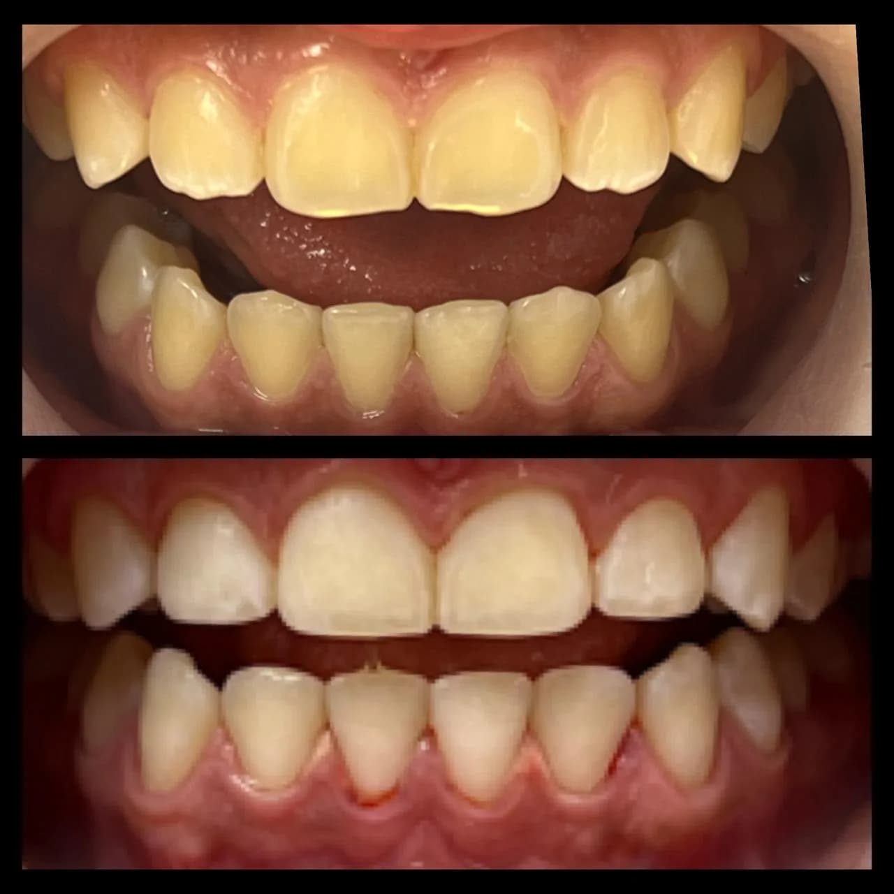 Caso de éxito de contorneo dental - Bifrancy Salazar 3