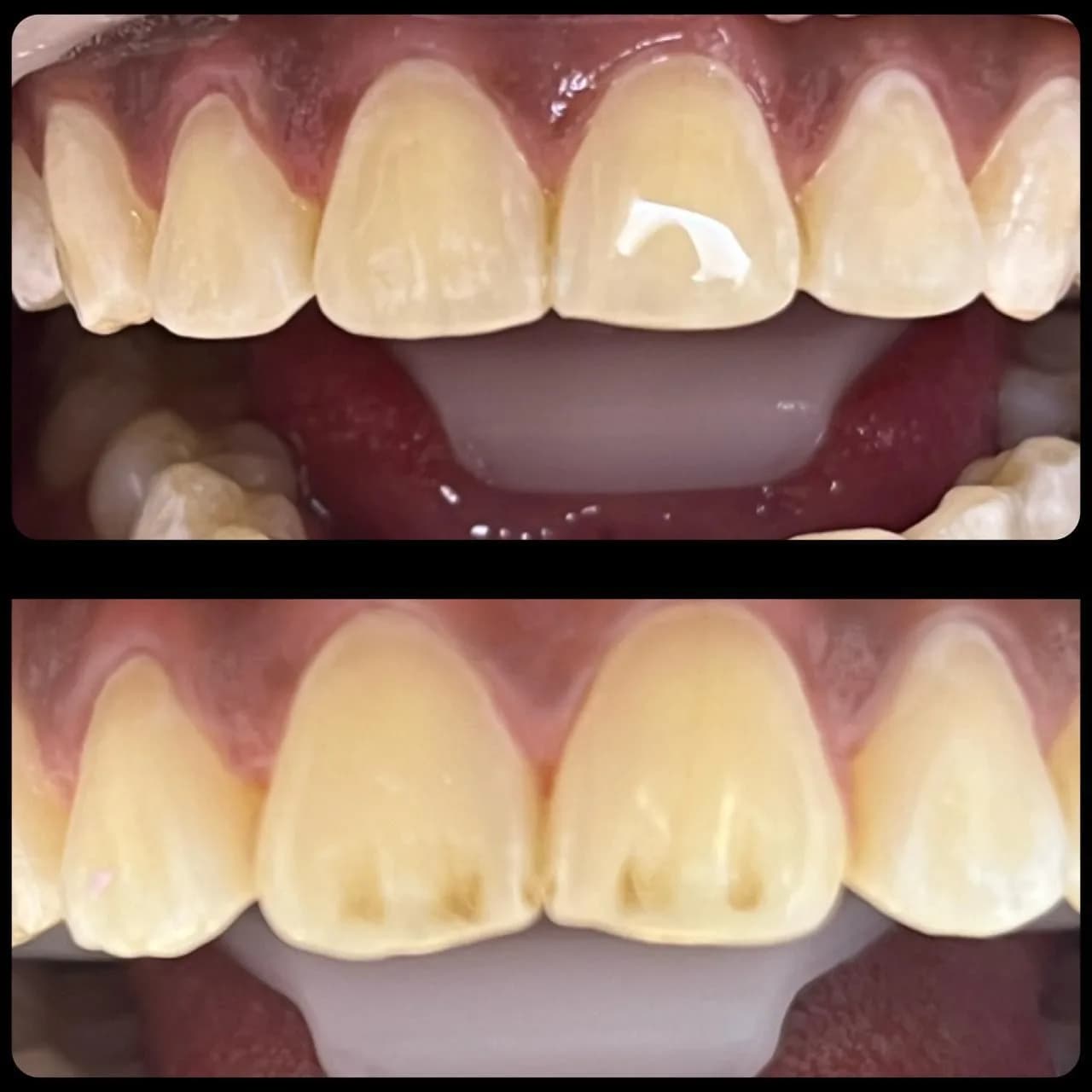 Caso de éxito de micropulido dental - Bifrancy Salazar 4