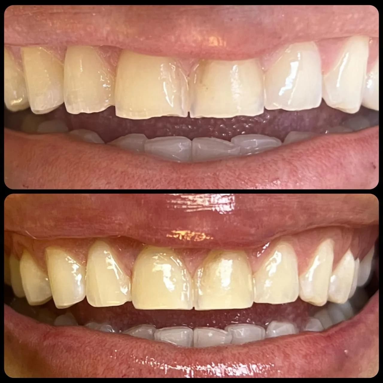 Caso de éxito de micropulido dental - Bifrancy Salazar 5