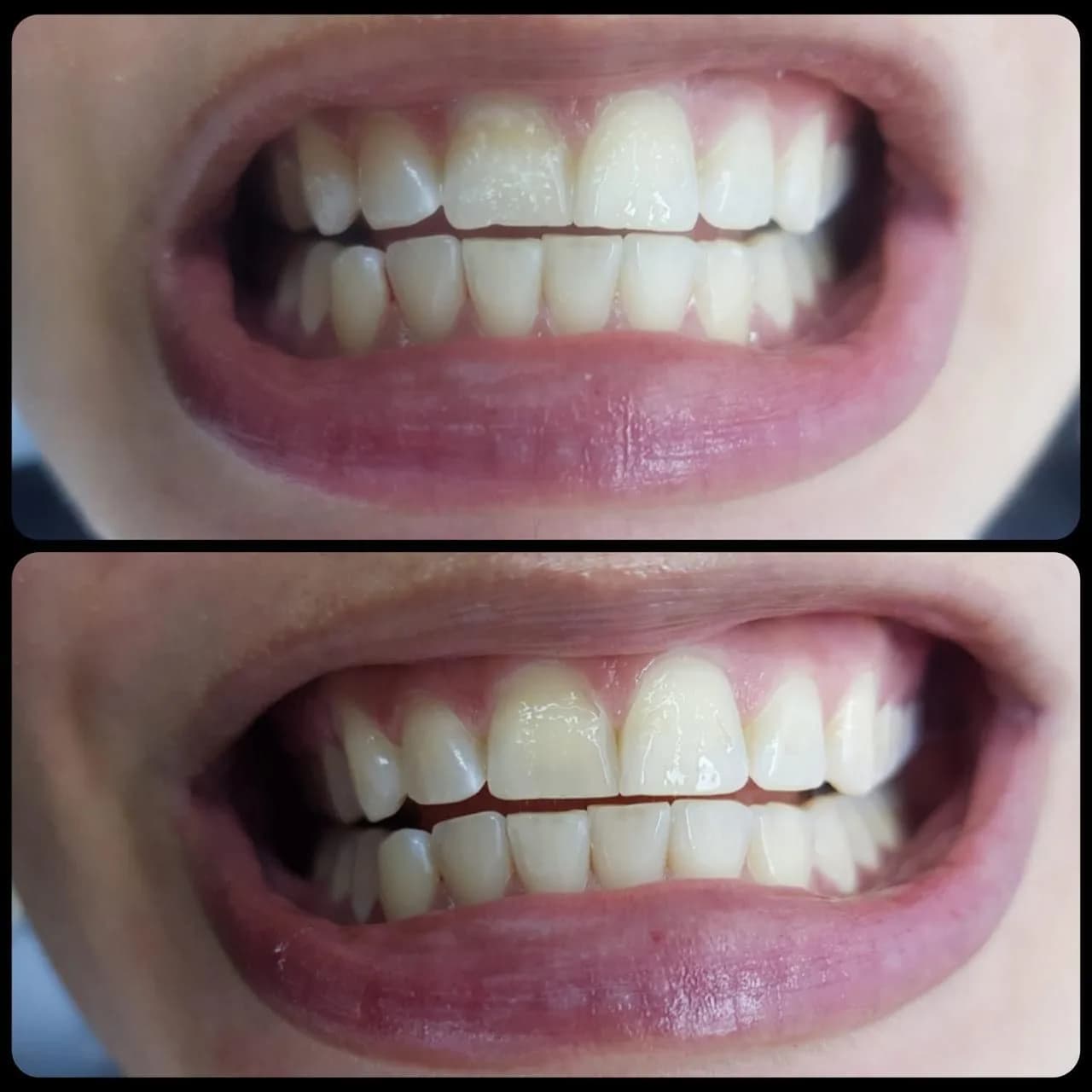 Caso de éxito de micropulido dental - Bifrancy Salazar 6