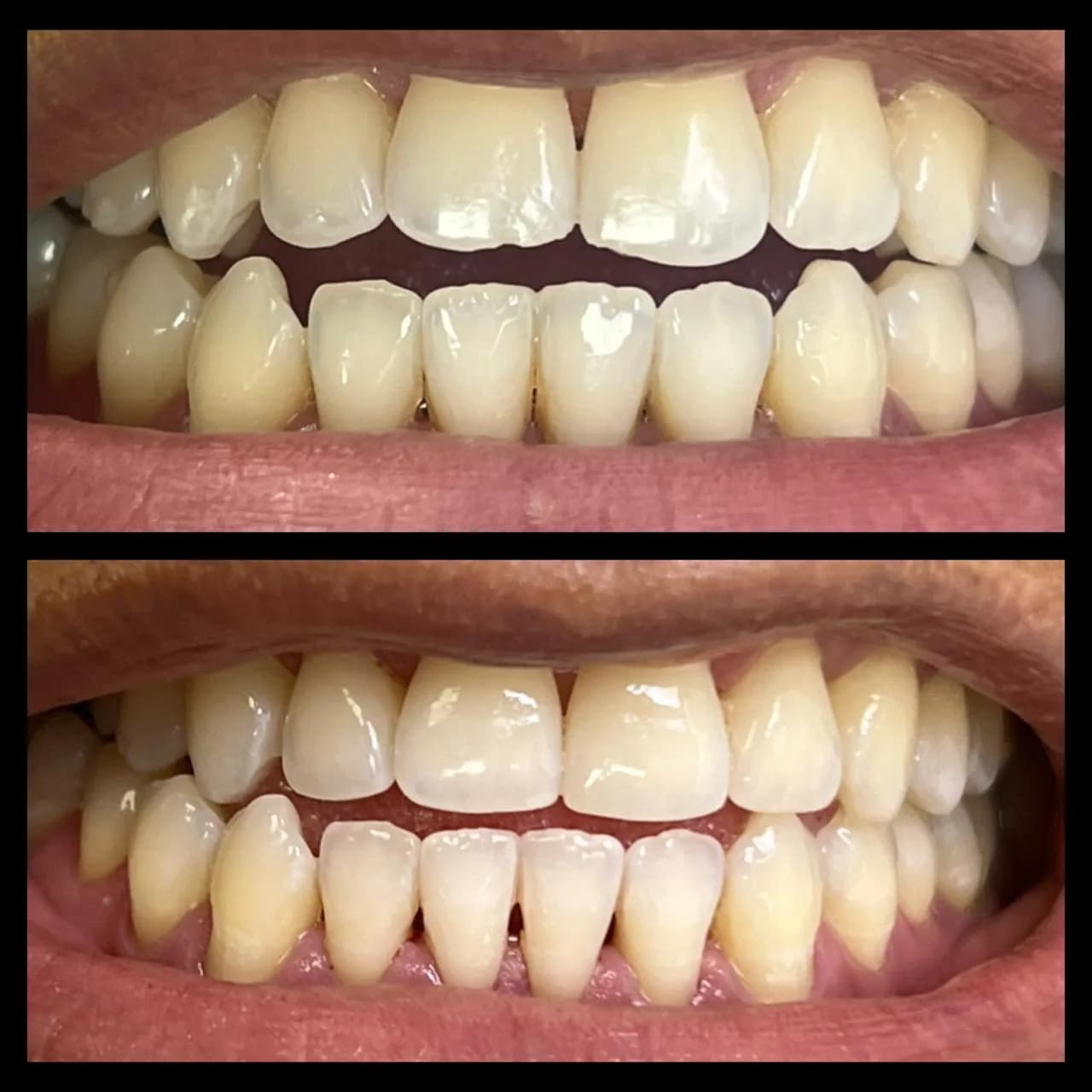 Caso de éxito de micropulido dental - Bifrancy Salazar 6
