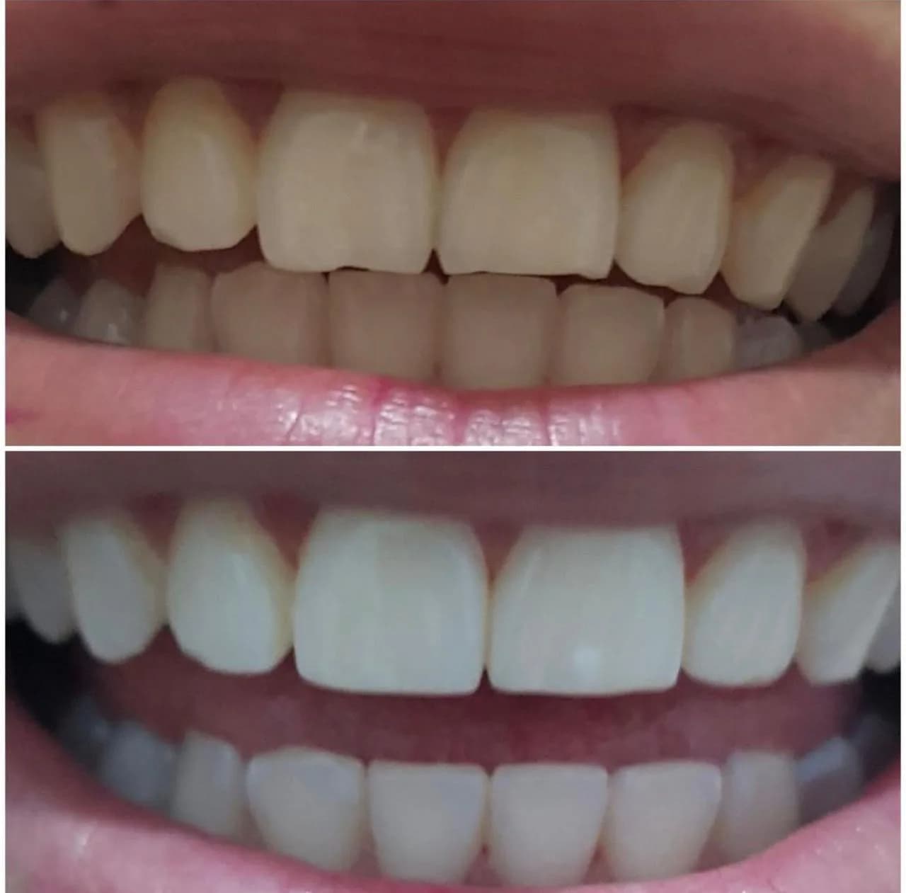Caso de éxito de micropulido dental - Bifrancy Salazar 6