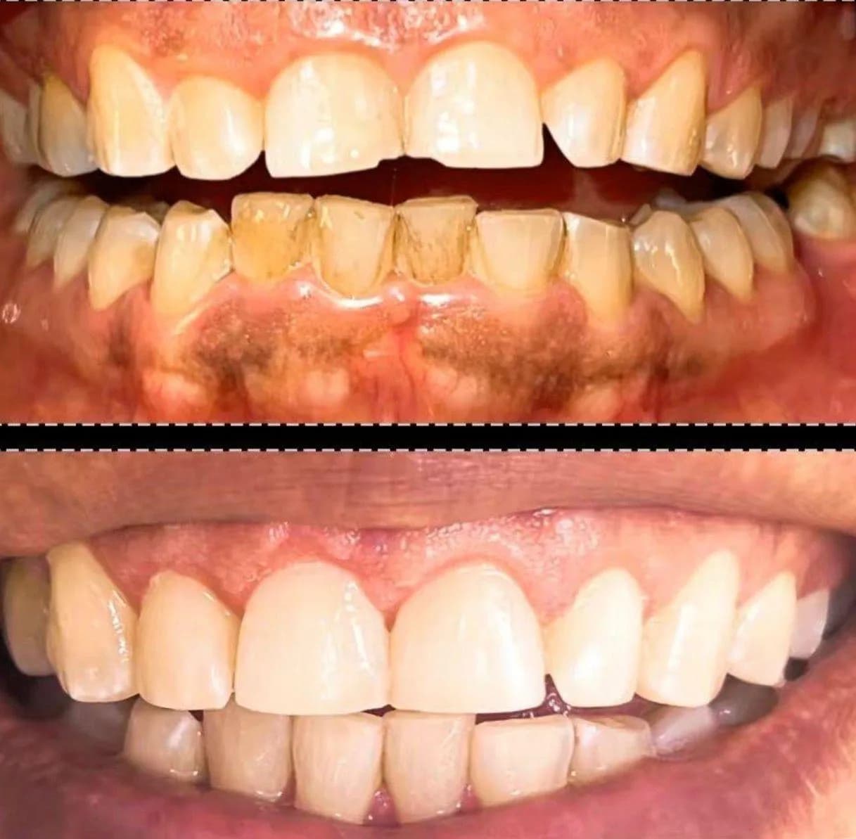 Caso de éxito de micropulido dental - Bifrancy Salazar 6